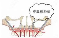 穿翼板種植牙