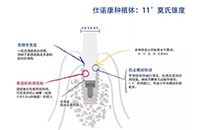 韓國(guó)仕諾康snuc種植牙