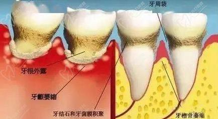 牙周疾病和牙結石