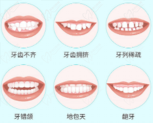 需要正畸情況