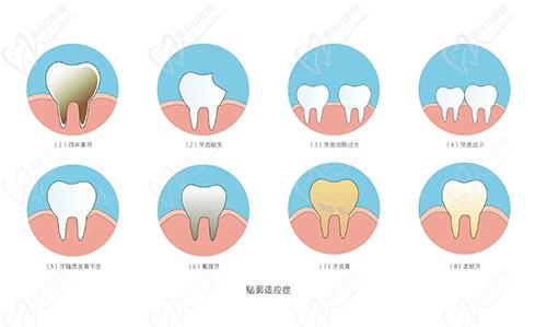 仿生復合瓷牙貼面適應人群