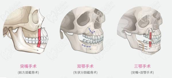 北京正頜手術(shù)費(fèi)用能報(bào)銷嗎