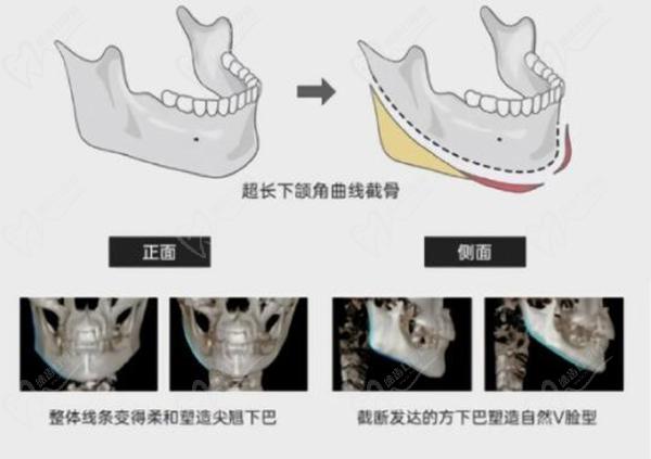 下巴截骨