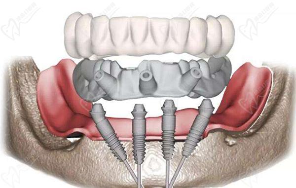 西安滿口種植牙allon4/allon6即刻負(fù)重種植價(jià)格