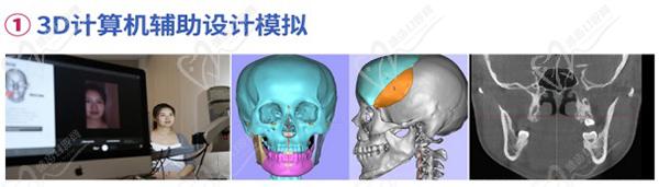 何錦泉正頜手術(shù)采用的是全新3D數(shù)字化頜面技術(shù)