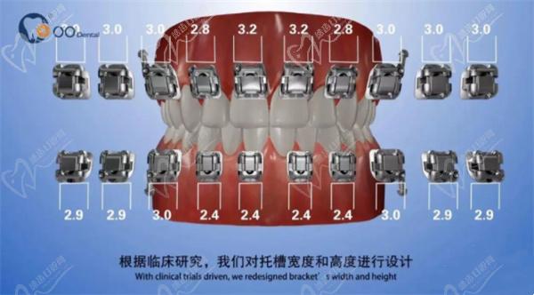 歐歐托槽矯正牙套