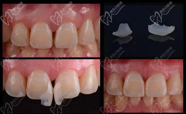 門牙貼面修復(fù)多少錢一顆