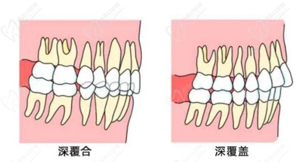 牙齒只深覆蓋正常嗎？深覆蓋有必要矯正嗎？看矯正后臉型變化