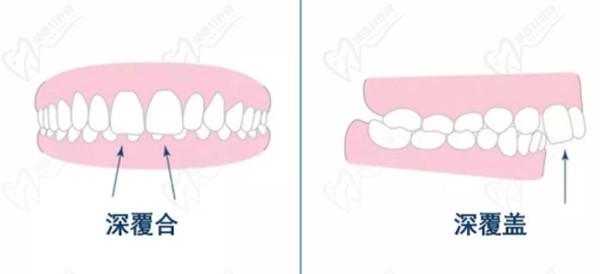 牙齒只深覆蓋正常嗎？深覆蓋有必要矯正嗎？看矯正后臉型變化