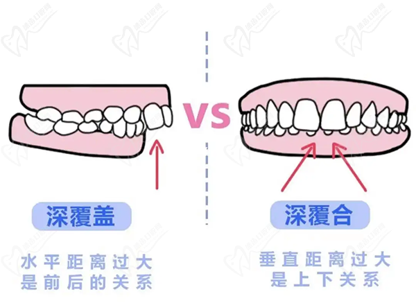 牙齒只深覆蓋正常嗎？深覆蓋有必要矯正嗎？看矯正后臉型變化