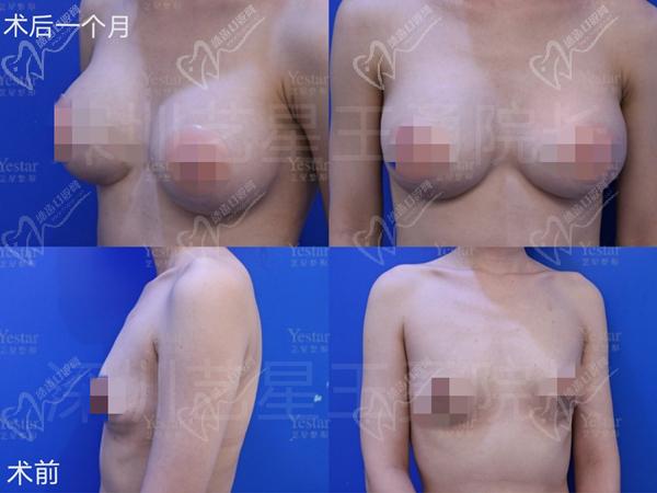 深圳藝星整形隆胸怎么樣