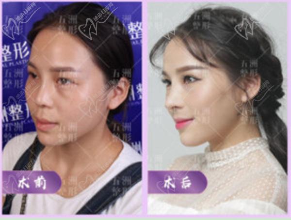 王志鼻整形手術(shù)圖片