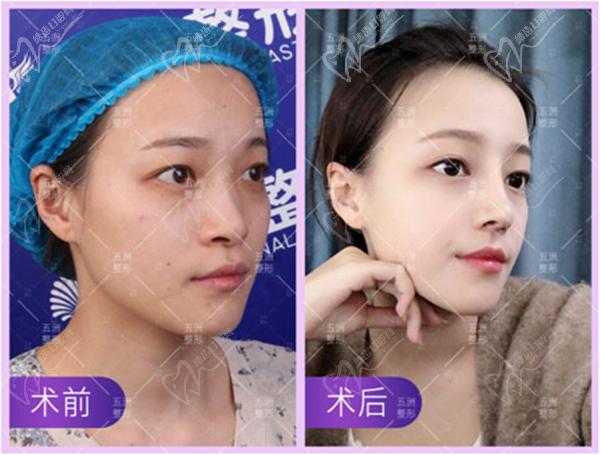 王志鼻整形手術(shù)圖片
