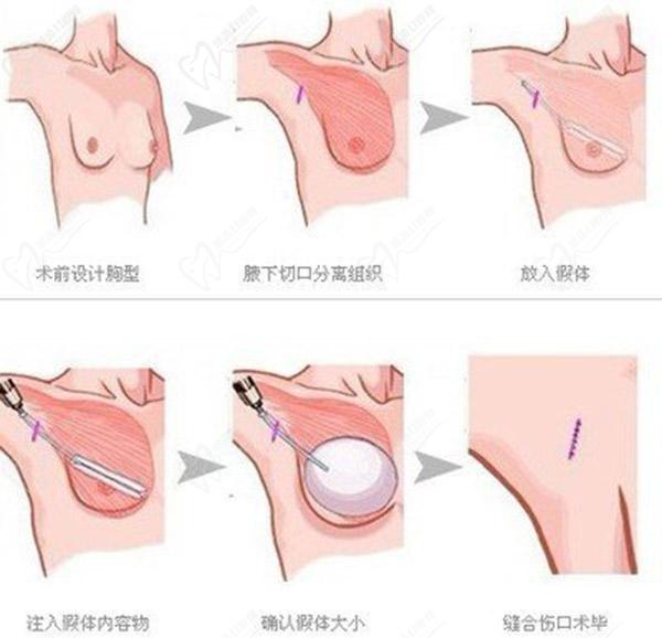 武漢五洲隆胸價(jià)格