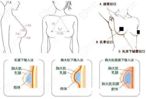 何賢清隆胸怎么樣
