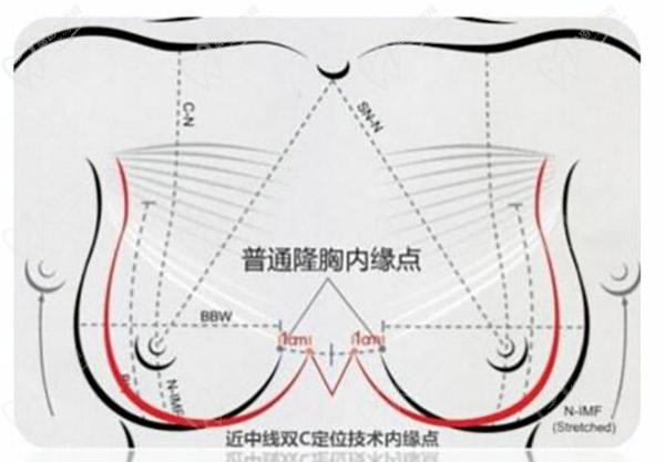隆胸