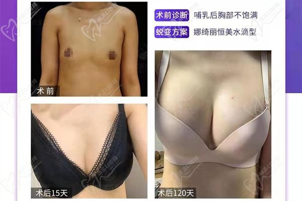北京米蘭柏羽麗都高超真人隆胸圖