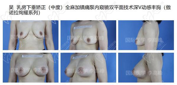 李高峰隆胸圖片