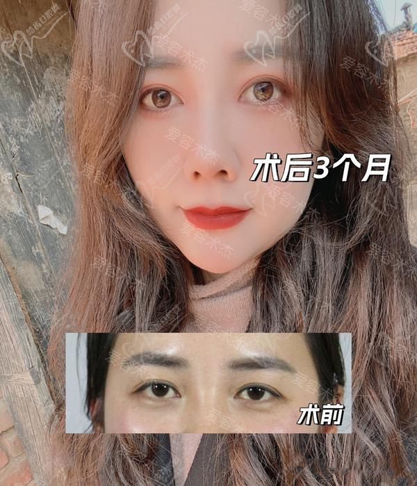 濟(jì)南愛容整形美容醫(yī)院雙眼皮案 例