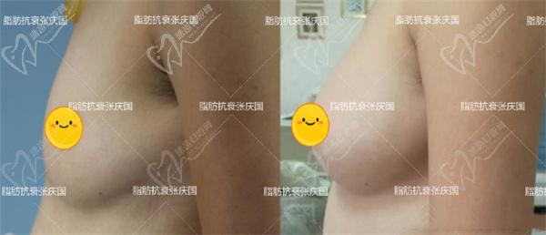 張慶國隆胸案 例