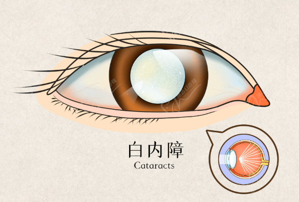 白內(nèi)障手術(shù)