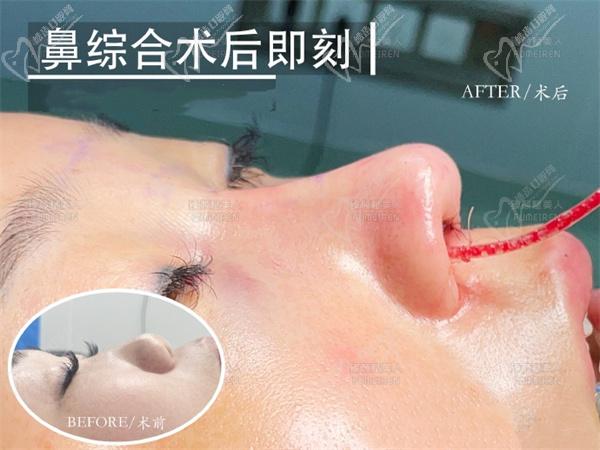 鄭州臻顏池凱隆鼻手術(shù)圖片