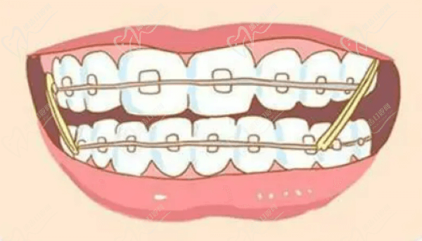 南京德牙聯(lián)合口腔普通托槽矯正價格