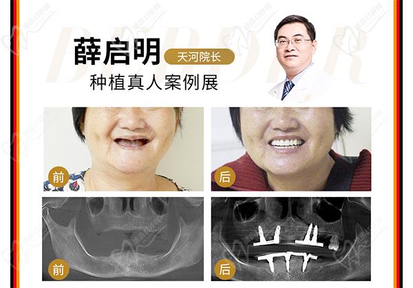 廣州柏德口腔醫(yī)院種植牙院長(zhǎng)[薛啟明]