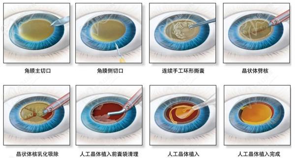 白內(nèi)障手術