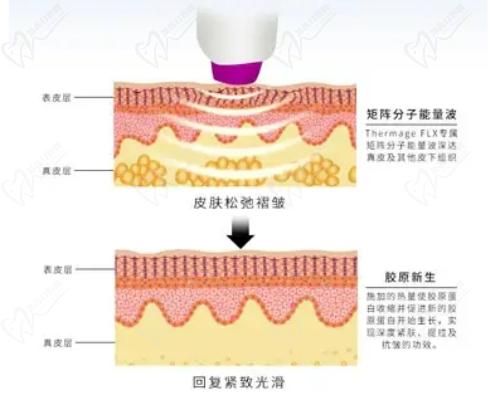 重慶軍科整形引進(jìn)超瑪吉FLX技術(shù)不錯(cuò)