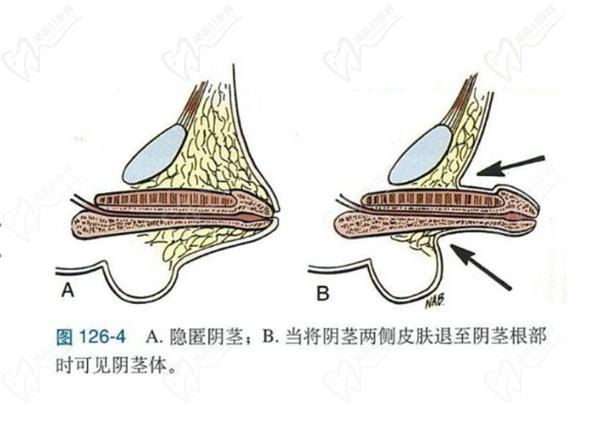 生殖延長整形手術(shù)多久有成效