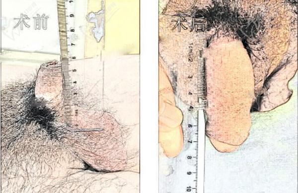 男性自體延長手術(shù)多少錢