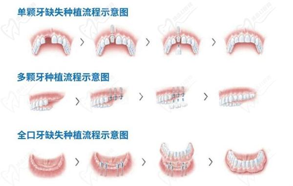 冠心病能種植牙嗎