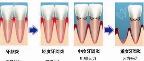 天津口腔醫(yī)院牙周炎刮治費(fèi)用