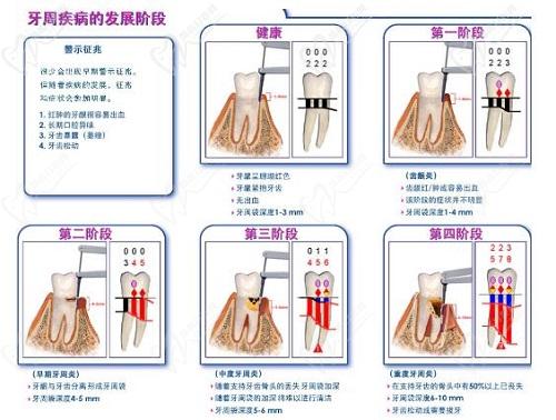 天津口腔醫(yī)院牙周炎刮治費(fèi)用