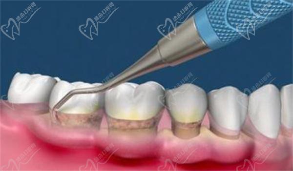 牙周刮治