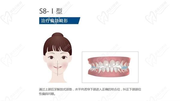 正雅隱形矯正牙套