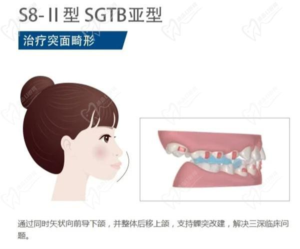 正雅隱形矯正牙套