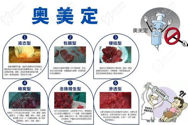 英捷爾法勒就是奧美定注射20年后胸脹疼痛