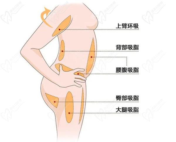 國內(nèi)抽脂手術(shù)多少錢一次