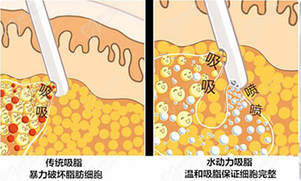 國(guó)內(nèi)吸脂價(jià)格表