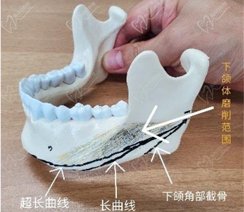 1:1下頜骨體塊堆砌理念