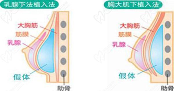 鄭州比較好的隆胸醫(yī)生名單