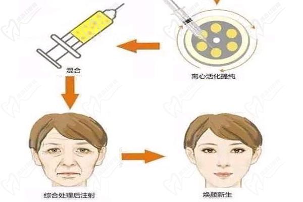 劉中 國吸脂怎么樣萃取