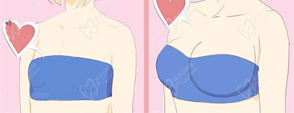 隆胸手術