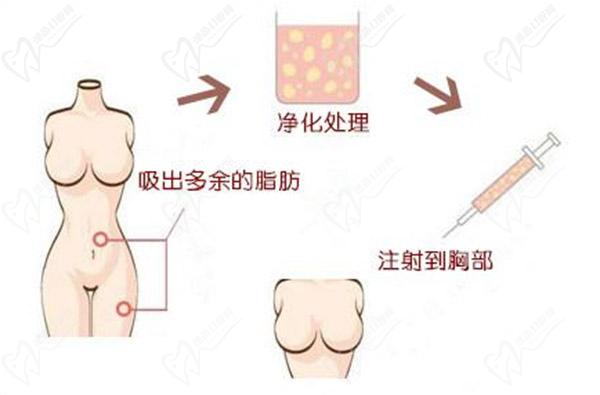 隆胸手術
