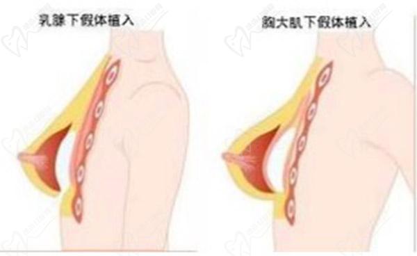隆胸手術