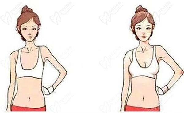 隆胸手術