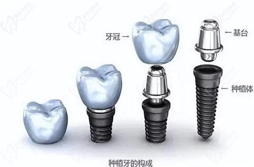 三、韓國種植體品牌對比：奧齒泰（Osstem）VS登騰（Dentium）