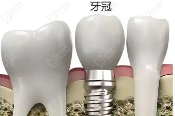 Ankylos的技術(shù)特點(diǎn)